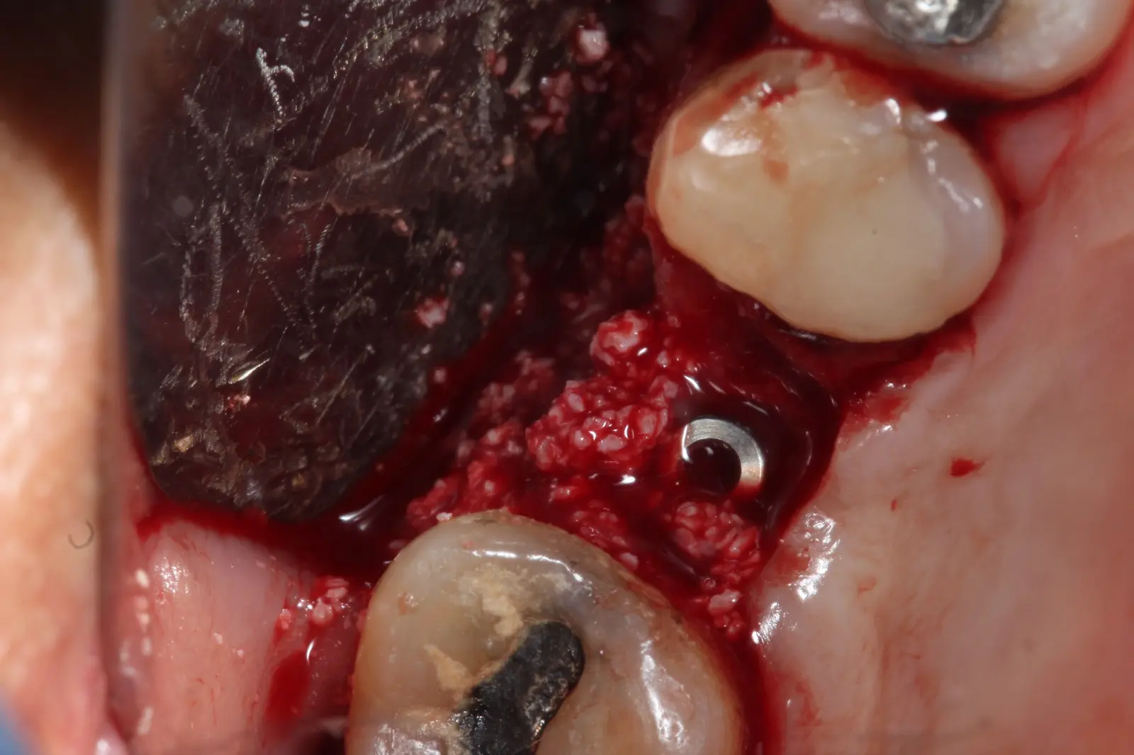implante dental en zona anterior